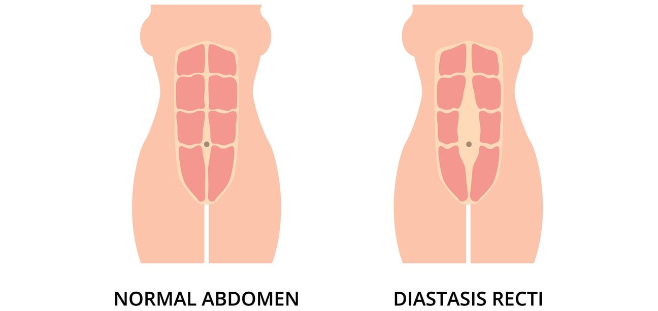 Músculos abdominais tonificados normais e retos de diástase, também conhecidos como separação abdominal, comum entre mulheres grávidas