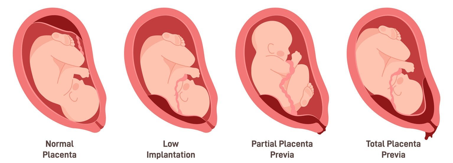 Diferentes localizações placentárias durante a gravidez.  Placenta prévia, total, baixa e parcial.  Conjunto de patologia da gravidez.