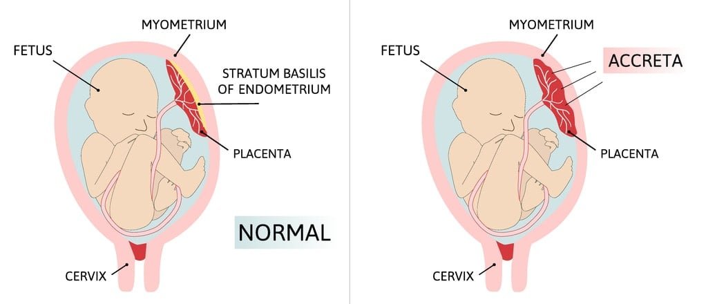 Placenta acreta.  parte da placenta se fixa de forma anormal ao miométrio.  Três graus de fixação anormal ilustrados de acordo com a profundidade: Accrete, increta, percreta.  ilustração vetorial médica colorida
