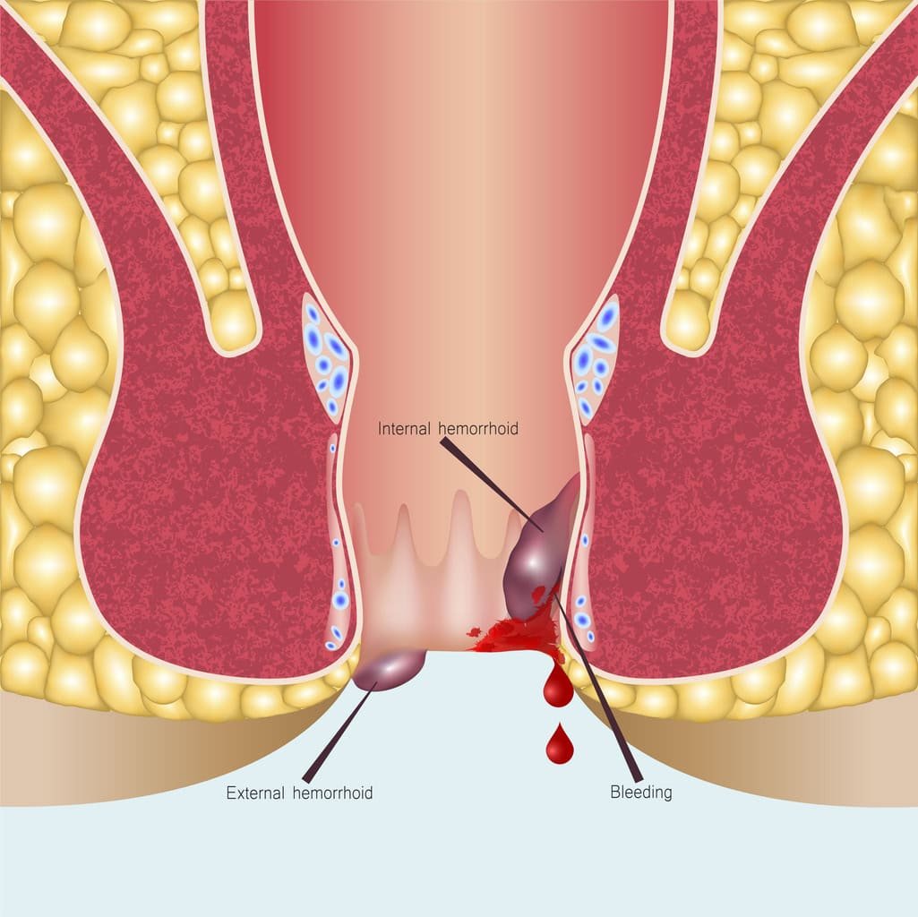 Uma ilustração médica mostrando uma vista transversal do canal anal.  As etiquetas apontam para hemorróidas internas, hemorróidas externas e uma área de sangramento.  Tecido gorduroso circunda o canal, e a ilustração destaca as diferentes camadas do tecido, além de sugerir hamamélis para o autocuidado de hemorróidas.