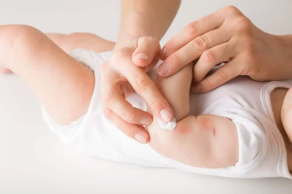 Uma mãe aplica suavemente creme para erupções cutâneas no braço do bebê, acalmando as marcas vermelhas que indicam os sintomas clássicos de erupções cutâneas. O bebê, com roupa branca, deita-se calmamente enquanto o foco permanece na aplicação suave deste tratamento eficaz para erupções cutâneas.